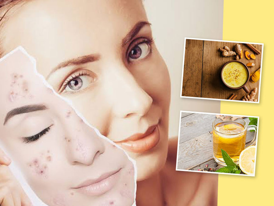 Tips for treating acne with green tea - simple and skin-friendly